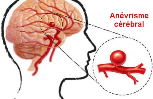 Anévrisme-cérébral-500x325-500x325-500x325