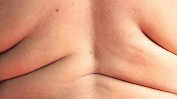 obésité surpoids graisse