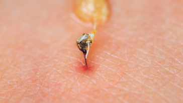 piqûre abeille