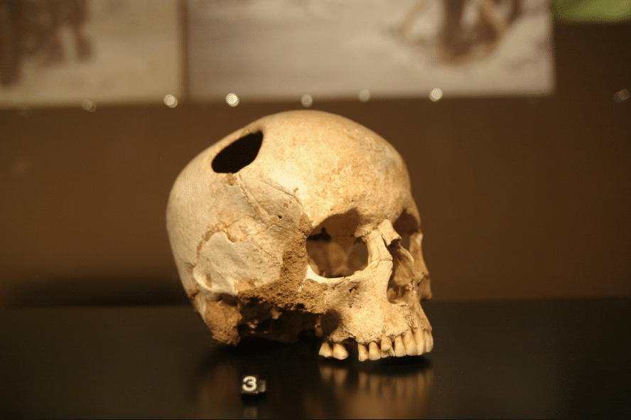 Crâne trépanation craniotomie