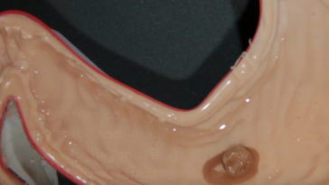 implant marqueur MIT