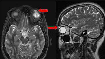 lentille contact paupière