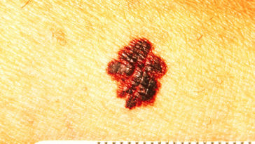 mélanome peau cancer