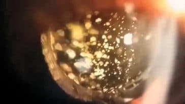 oeil hyalose astéroïde