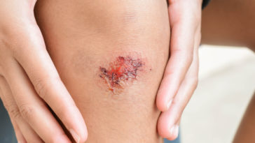 blessure genoux plaie