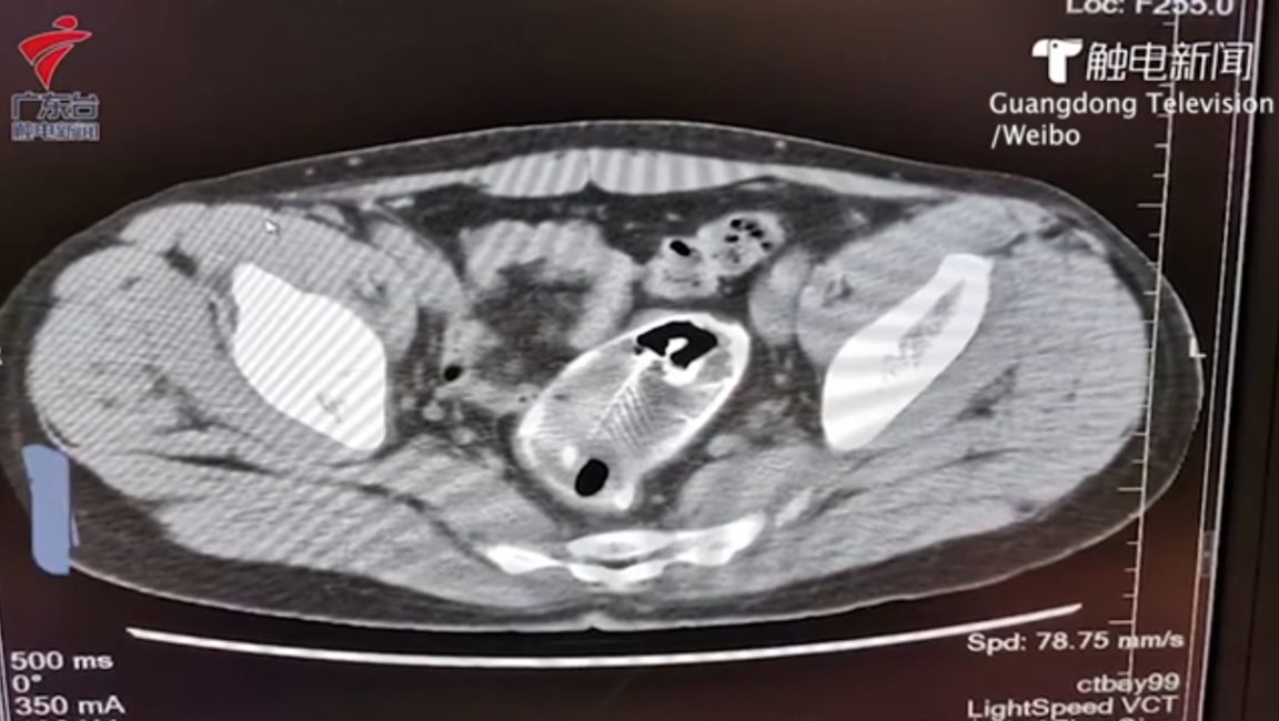 poisson coincé rectum 2