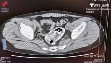 poisson coincé rectum 2