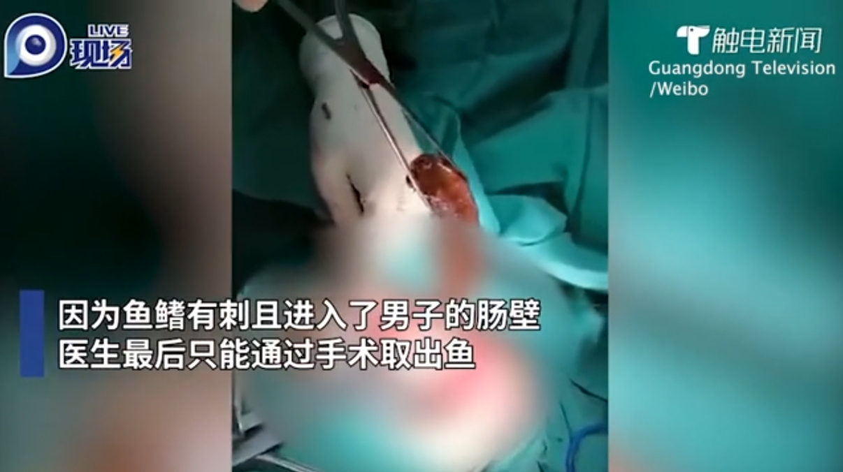 poisson coincé rectum