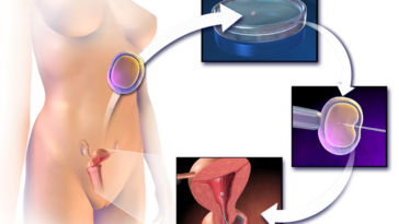 procréation médicalement assistée