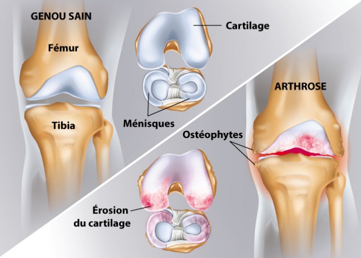 schéma arthrose genou