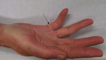 maladie de Dupuytren 2