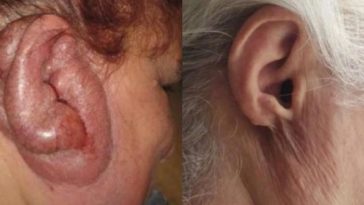 oreille de dinde tuberculose