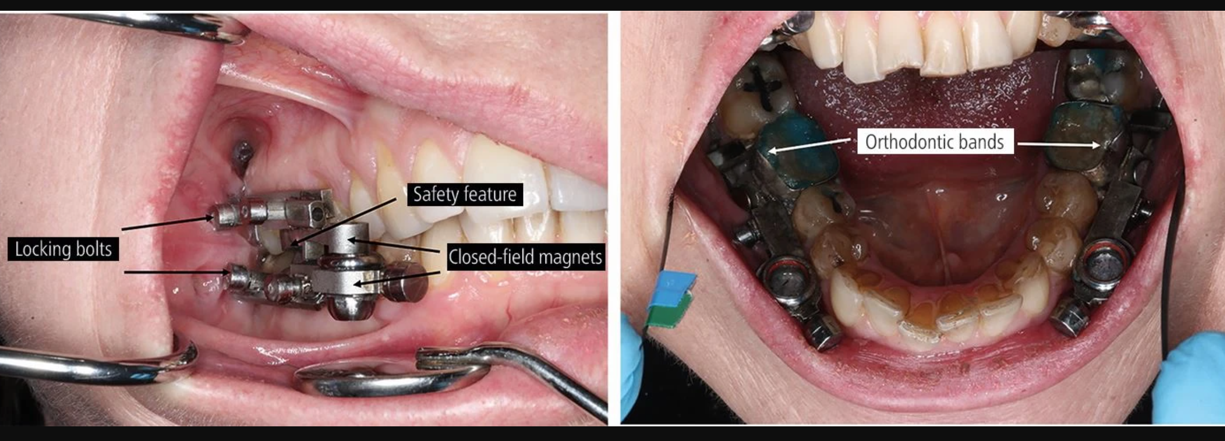 dentalslim regime minceur