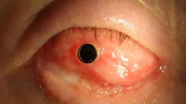 OOKP dent oeil implant 2