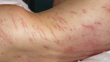 larves vers parasites