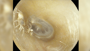 araignée oreille