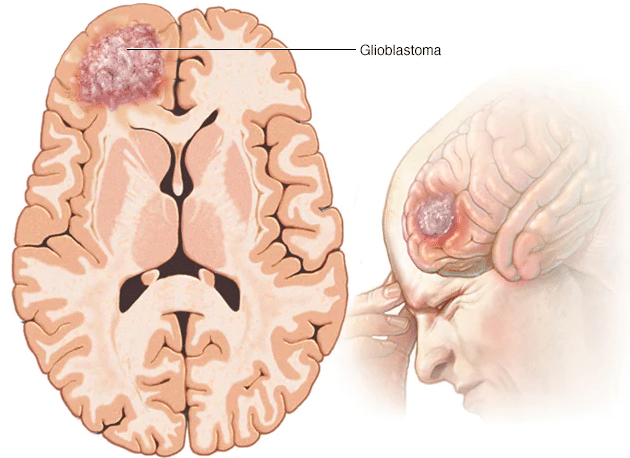 glioblastome