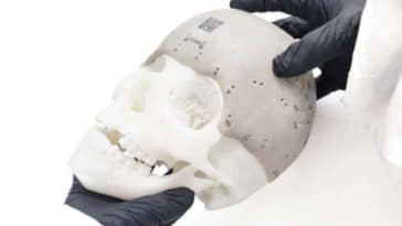 implant cranien 3D