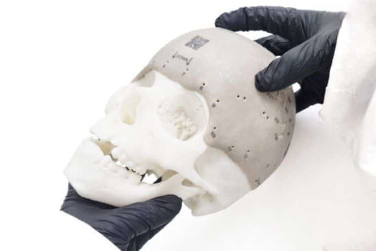 implant cranien 3D