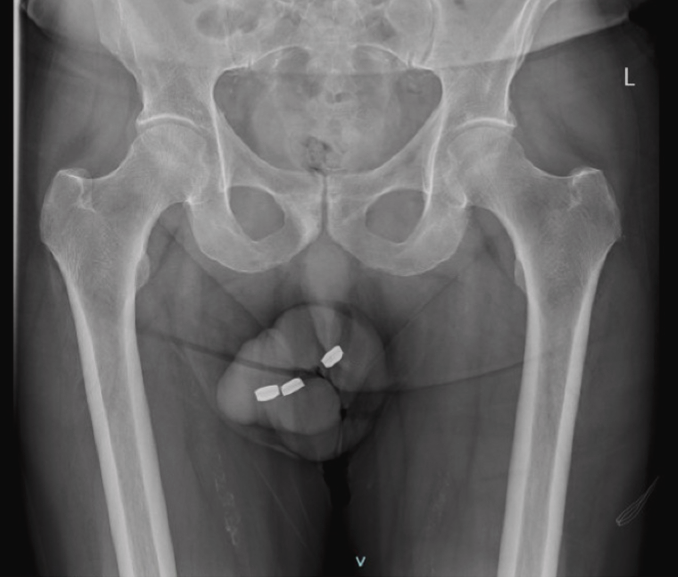 piles dans le pénis urètre