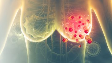 cancer du sein tumeur mammaire