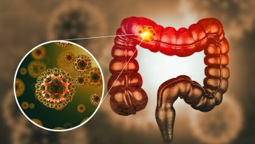 Cancer du côlon cancer colorectal tumeur maligne cellules cancéreuses