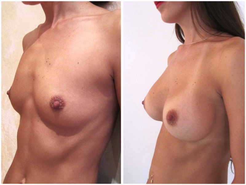 augmentation mammaire avant après femme