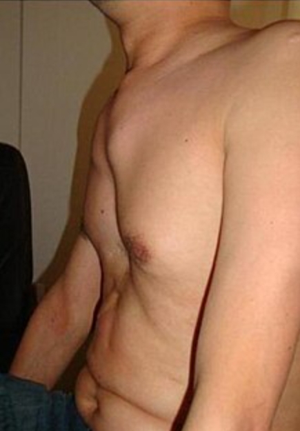 syndrome marfan déformation