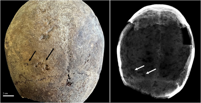 cerveaux XVIIe siècle cocaïne