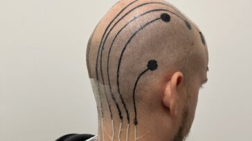 électrodes tatouages