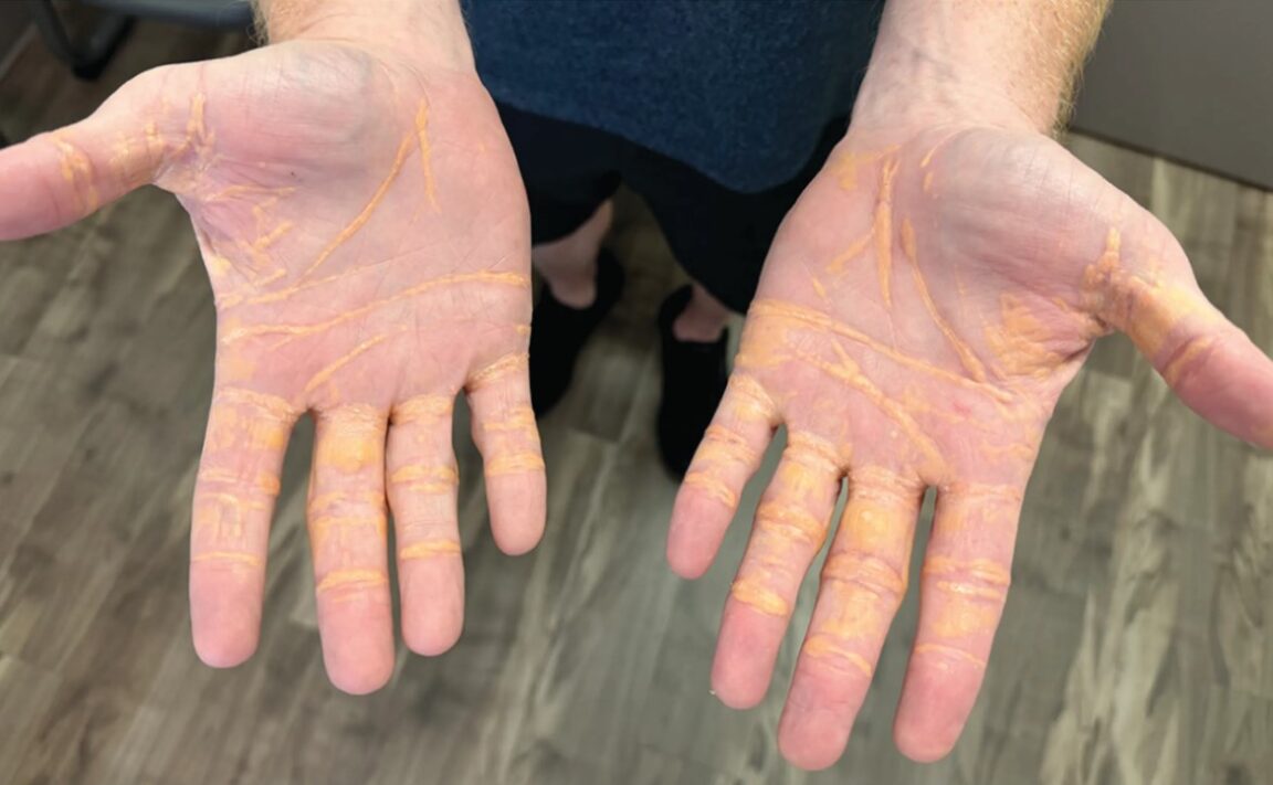 régime carnivore mains qui suintent du cholestérol xanthélasma