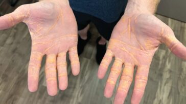 régime carnivore mains qui suintent du cholestérol xanthélasma