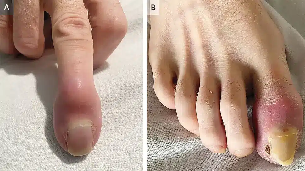 doigt gonflé cancer