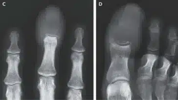 doigt gonflé cancer