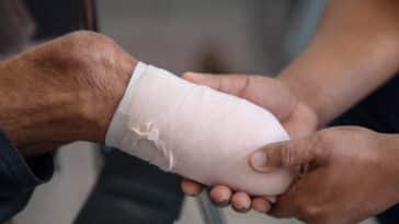 amputé amputation cerveau